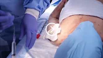 Cadaveric - Site Identification/ Insertion video image