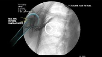 Fluoroscopic View of Flow video image