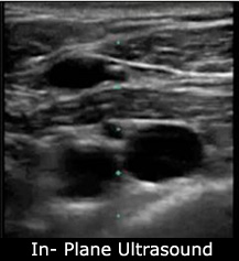 in plane ultrasound