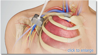 right axillary with probe