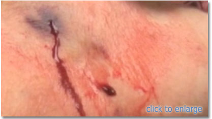 bleeding complications