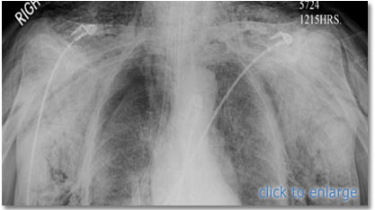 pneumothorax xray