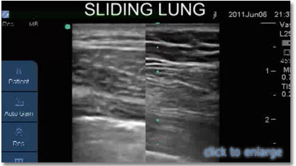 sliding lung