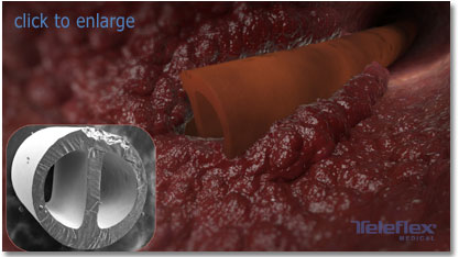 thrombosis formation