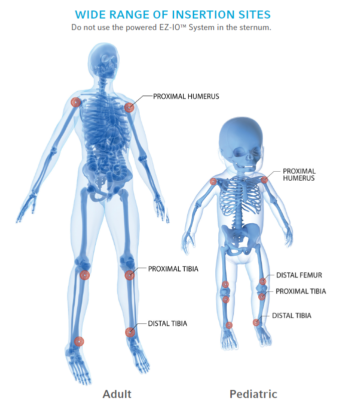 Skeleton Image of EZ-IO Insertion sites